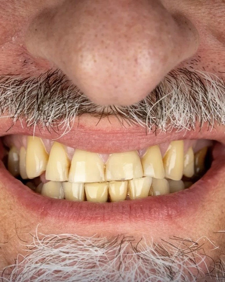 Smile transformation 1