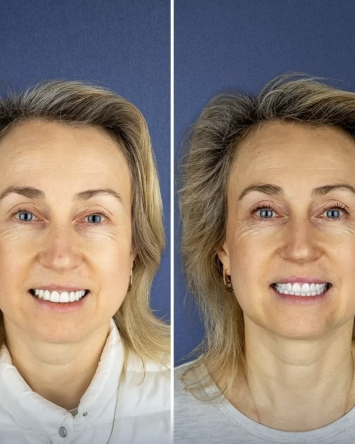Teeth whitening