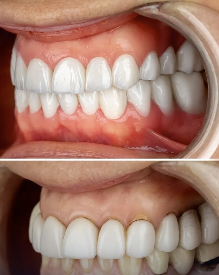 Porcelain veneers