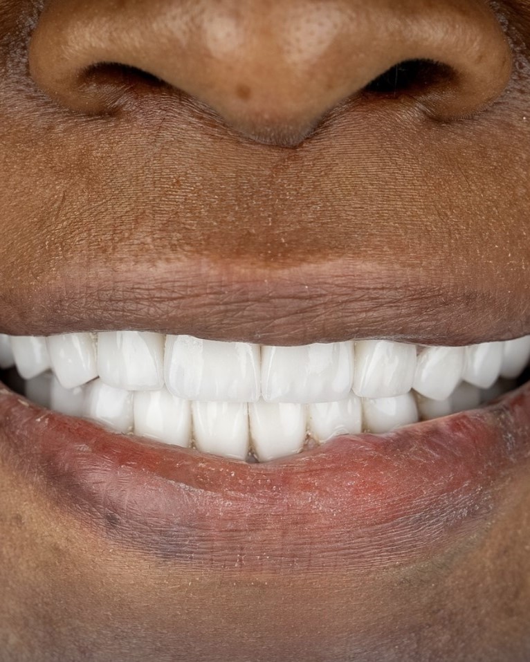 Root canal treatment