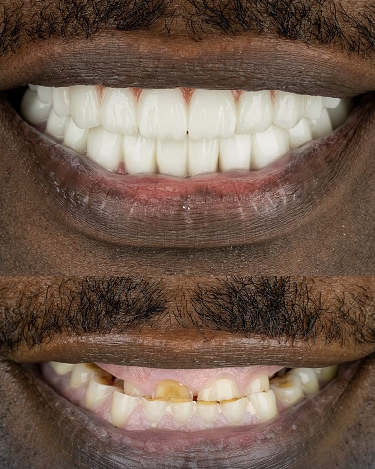 Gum treatment