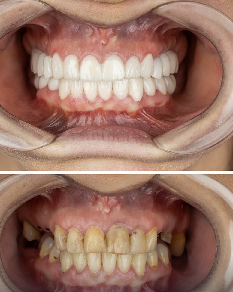 Intraoral scanner